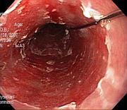 Barrett's Oesophagus on endoscopy Barrett's Oesophagus on endoscopy