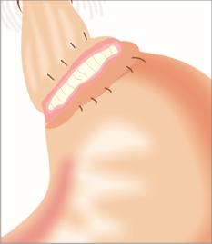 Gastric-Band-Removed