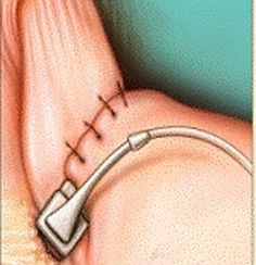 Gastric-Band-Sutured