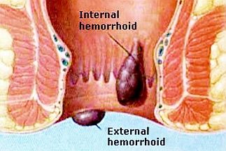 Internal and External Haemorrhoids