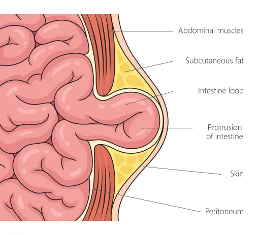 Abdomina wall hernia Abdominal wall hernia
