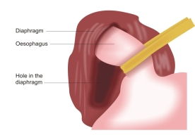Nissen-Fundoplication-Returning-Stomach-Into-Abddomen