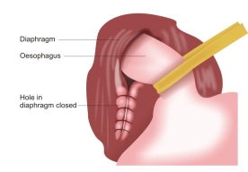 Nissen-Fundoplicaiton-Closing-Hole-In-Diaphragm
