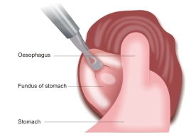 Nissen-Fundoplicaiton-Wraping-Stomach-Around-Oesophagus