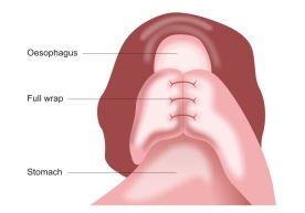 Nissen-Fundoplication