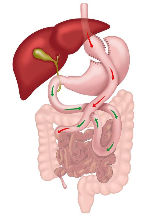 Roux-en-Y Gastric Bypass Procedure Illustration
