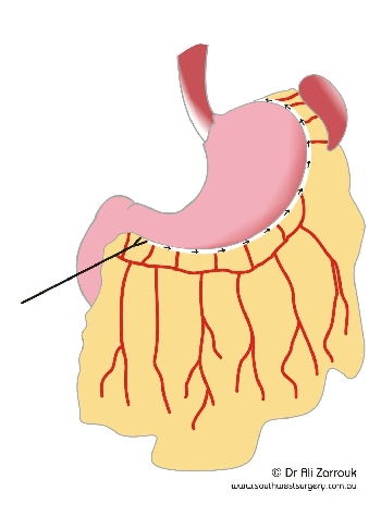Sleeve Gastrecomy - Freeing the stomach
