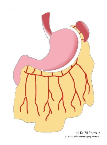 Sleeve Gastrectomy - Stomach Freed from Omentum and Spleen