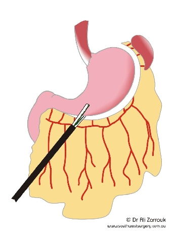 Sleeve Gastrectomy - Stapling and Dividing
