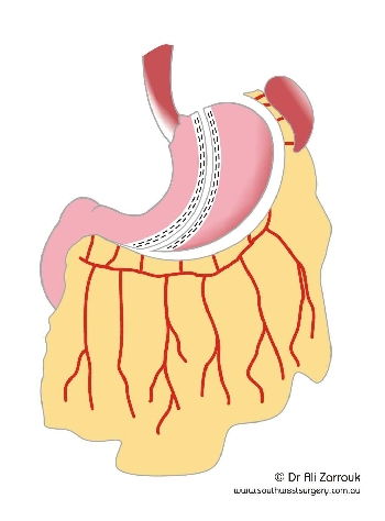Sleeve Gastrectomy - Stomach Division Completed