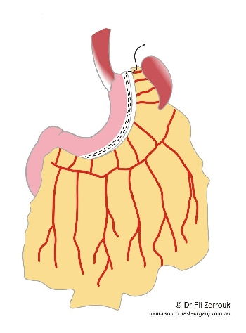 Sleeve Gastrectomy - Suturing the staple line
