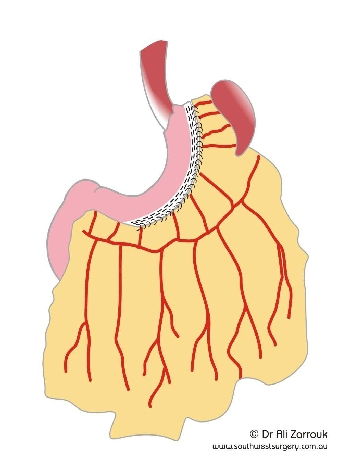 Sleeve Gastrectomy - Final Result