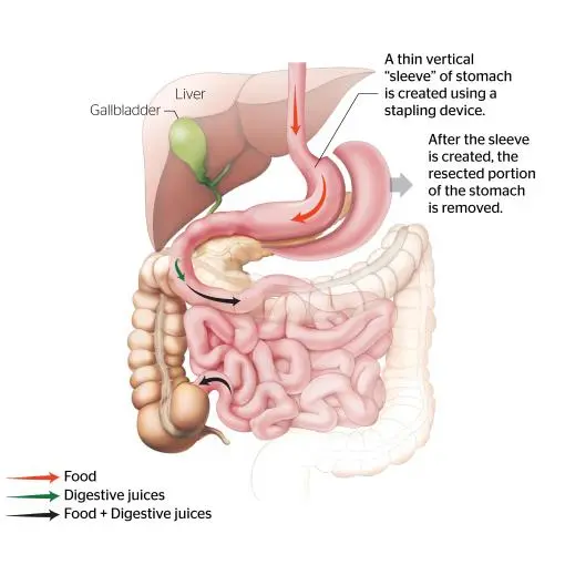 Sleeve Gastrectomy