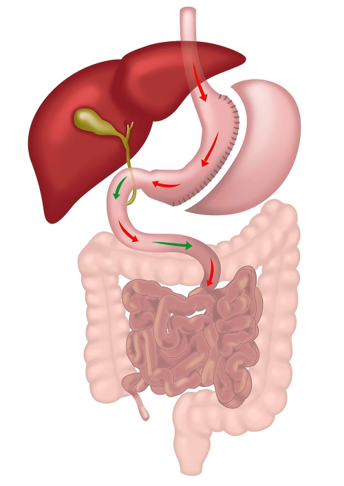 Sleeve Gastrectomy Procedure Illustration