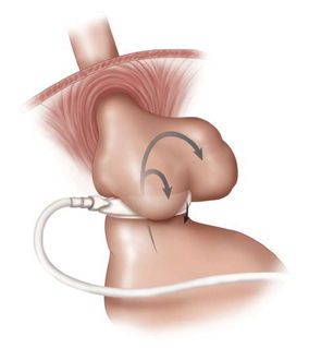 Slipped Gastric Band