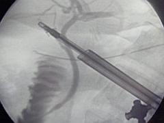 Intraoperative cholangiogram
