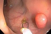 colon polyp about to be removed with snare