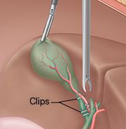 Laparoscopic gallbladder surgery ports