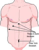 Gallbladder surgery incisions