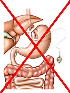 gastric-banding