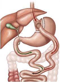 Roux en Y Gastric Bypass 