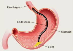 Gastroscopy