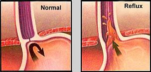acid reflux illustration acid reflux illustration