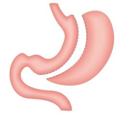 Sleeve Gastrectomy