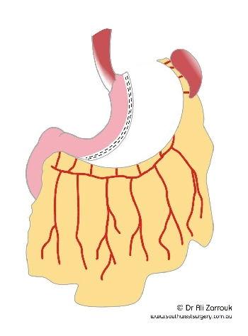 Sleeve Gastrectomy Before Suturing
