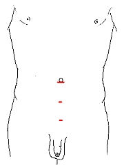 Laparoscopic Bilateral Inguinal Hernia Repair