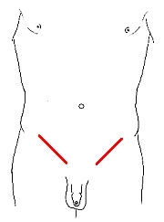 Open Bialteral Inghuinal Hernia Repair